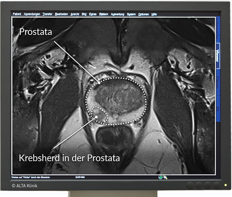 Prostata Erhaltende Therapie Mit Mrt Hifu 