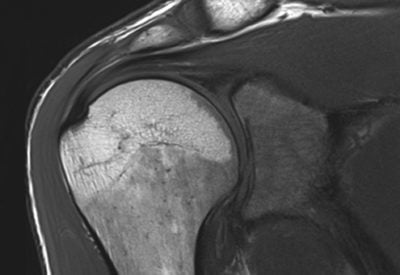 MRT Schulter Diagnose: Sehnenriss & Entzündung Schnell Erkennen – ALTA ...